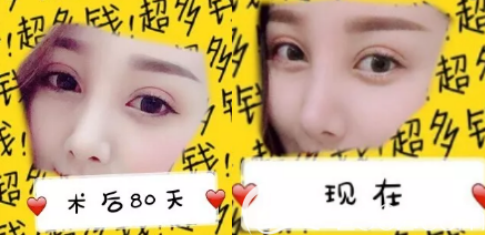 濟(jì)南寶琳娜做隆鼻手術(shù)挺好的，給大家解釋下隆鼻術(shù)后多久恢復(fù)