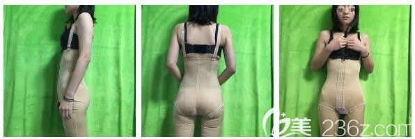 朱如崗醫(yī)生建議做完水動(dòng)力腰腹部吸脂術(shù)后穿著塑身衣 朱如崗醫(yī)生建議做完水動(dòng)力腰腹部吸脂術(shù)后穿著塑身衣
