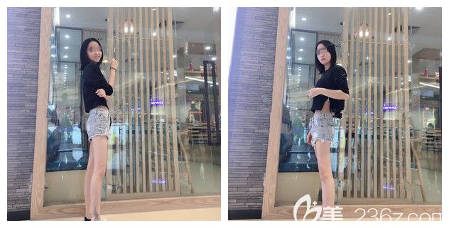 擔(dān)心夏天露臍裝暴露自己的肉肉所以提前已經(jīng)到南通儷人找朱如崗醫(yī)生做了腰腹部吸脂 差不多一月后疼痛感完全消失