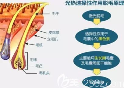 冰點(diǎn)脫毛的作用原理介紹