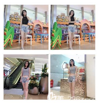 到南通儷人連天美做腰腹部吸脂術(shù)后效果 到南通儷人連天美做腰腹部吸脂術(shù)后效果