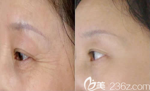 韓國ls整形美容外科去皺案例效果對比圖 韓國ls整形美容外科去皺案例效果對比圖