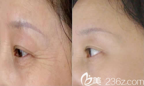 韓國(guó)LS整形美容外科洪榮晙院長(zhǎng)眼部除皺案例效果對(duì)比圖