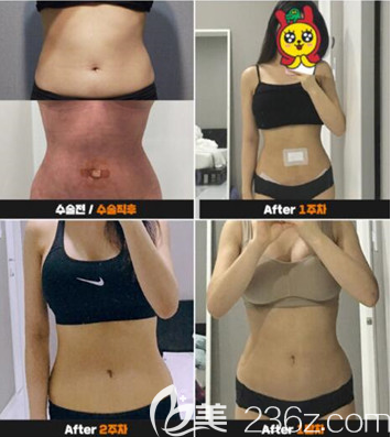 韓國babiline整形外科醫(yī)院腰腹吸脂案例效果對(duì)比圖