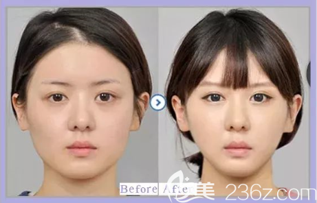 貴陽(yáng)美貝爾瘦臉效果好不好？