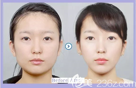 貴陽(yáng)美貝爾瘦臉效果