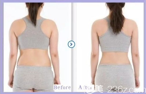 貴陽(yáng)美貝爾吸脂減肥怎么樣