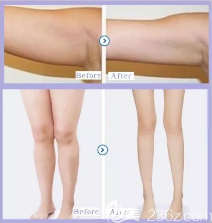 上臂吸脂和腿部吸脂效果