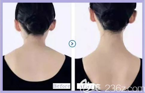 貴陽(yáng)美貝爾瘦肩