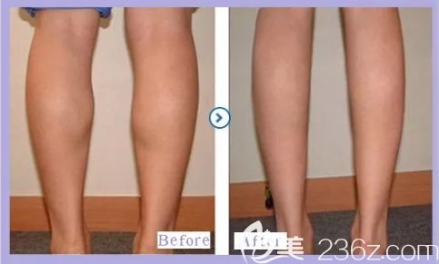 貴陽(yáng)美貝爾瘦小腿