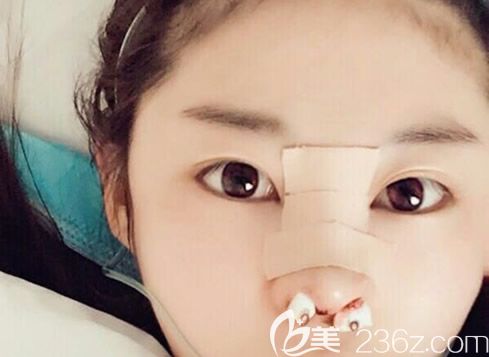 呼和浩特五洲醫(yī)院自體肋軟骨隆鼻前 呼和浩特五洲醫(yī)院自體肋軟骨隆鼻前