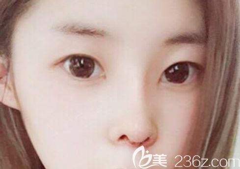 呼市五洲王煥假體隆鼻+自體軟骨隆鼻第五天圖片 呼市五洲王煥假體隆鼻+自體軟骨隆鼻第五天圖片