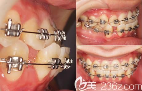 在<!--<i data=20240703-sp></i>-->口腔做正畸前的牙齒反頜照片 在<!--<i data=20240703-sp></i>-->口腔做正畸前的牙齒反頜照片