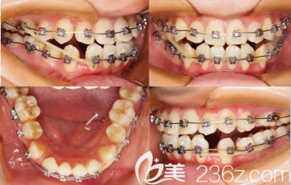 在<!--<i data=20240703-sp></i>-->口腔矯正3個(gè)月時(shí)照片 在<!--<i data=20240703-sp></i>-->口腔矯正3個(gè)月時(shí)照片