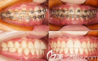 地包天矯正一年沒效果，后轉(zhuǎn)診口腔才解除我的牙齒反頜