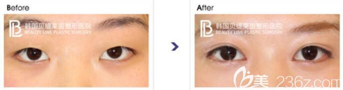 韓國貝緹萊茵整形醫(yī)院韓式雙眼皮案例效果對比圖 韓國貝緹萊茵整形醫(yī)院韓式雙眼皮案例效果對比圖