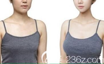 韓國貝緹萊茵整形醫(yī)院假體隆胸真人案例 韓國貝緹萊茵整形醫(yī)院假體隆胸真人案例