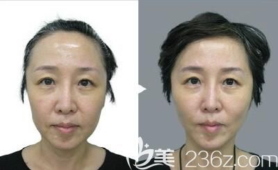 韓國貝緹萊茵埋線提升+納米面吸案例 韓國貝緹萊茵埋線提升+納米面吸案例