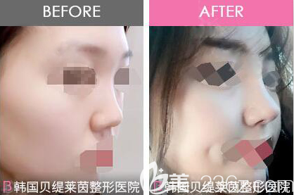 韓國貝緹萊茵整形醫(yī)院隆鼻案例 韓國貝緹萊茵整形醫(yī)院隆鼻案例