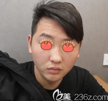 杭州美萊做自體脂肪填充面部前 杭州美萊做自體脂肪填充面部前