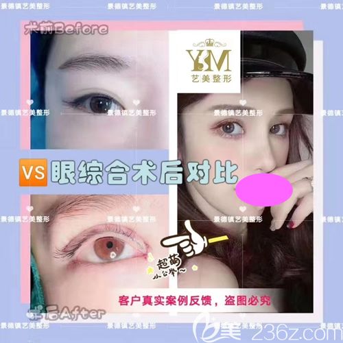 景德鎮(zhèn)藝美整形<!--<i data=20240703-sp></i>-->做的眼綜合術后對比圖 景德鎮(zhèn)藝美整形<!--<i data=20240703-sp></i>-->做的眼綜合術后對比圖