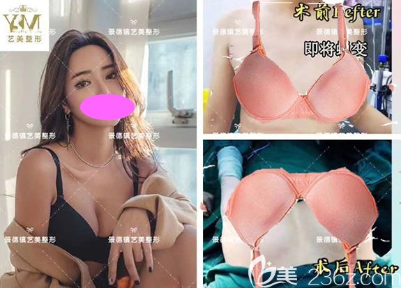 景德鎮(zhèn)藝美整形安薇做的曼托水滴隆胸前后對比圖 景德鎮(zhèn)藝美整形安薇做的曼托水滴隆胸前后對比圖
