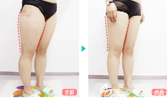 北京純脂馮斌醫(yī)生大小腿吸脂實例