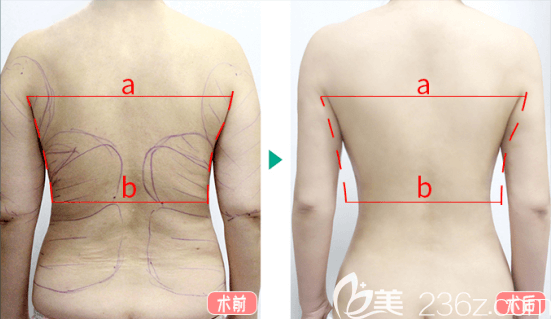 北京純脂馮斌醫(yī)生后背吸脂實例