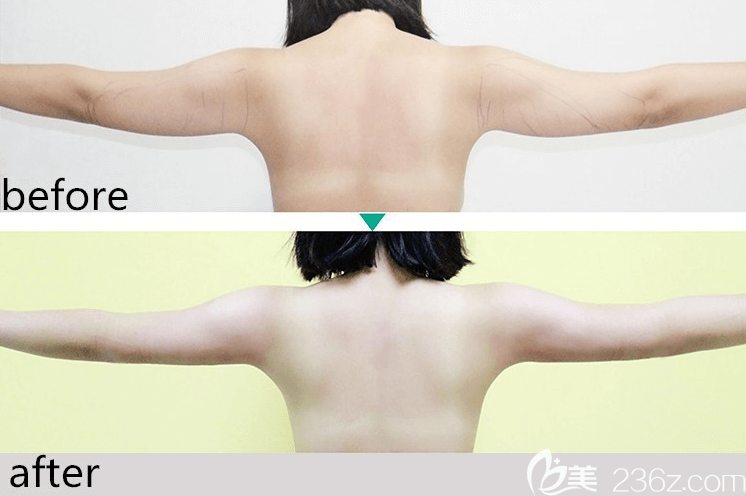 北京純脂馮斌醫(yī)生手臂吸脂實例