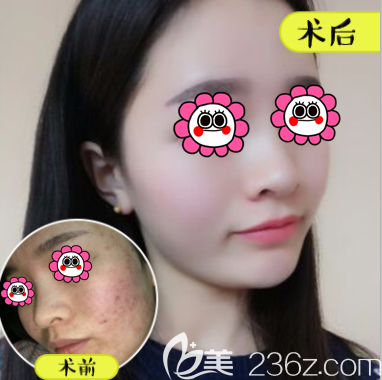 紅藍(lán)光祛痘案例效果展示