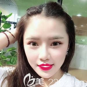 在石家莊雅芳亞做面部填充術(shù)后15天消除腫脹 在石家莊雅芳亞做面部填充術(shù)后15天消除腫脹