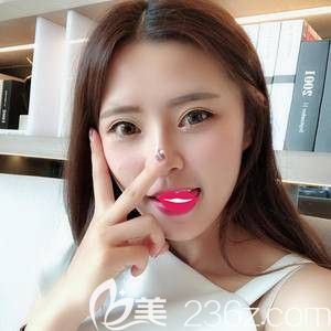 都羨慕我天生一張飽滿心形臉 其實是在石家莊雅芳亞找馮艷中醫(yī)生做了全面部自體脂肪填充術(shù)