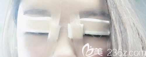 我找景德鎮(zhèn)藝美虞國鋒割7mm開扇形雙眼皮術(shù)后即刻圖 我找景德鎮(zhèn)藝美虞國鋒割7mm開扇形雙眼皮術(shù)后即刻圖