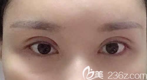 我找景德鎮(zhèn)藝美虞國鋒割7mm開扇形雙眼皮術(shù)后第10天恢復(fù)效果圖 我找景德鎮(zhèn)藝美虞國鋒割7mm開扇形雙眼皮術(shù)后第10天恢復(fù)效果圖