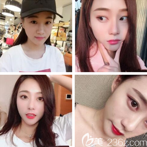 遵義利美康雙眼皮怎么樣