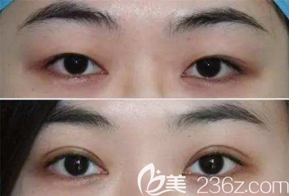 貴陽(yáng)哪個(gè)醫(yī)院割雙眼皮好