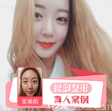 貴州利美康雙眼皮案例