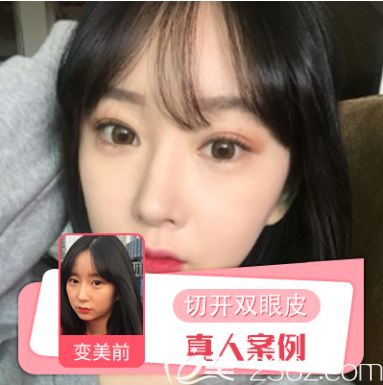 <!--<i data=20240703-sp></i>-->切開(kāi)雙眼皮