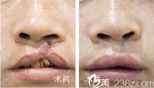<!--<i data=20240703-sp></i>-->唇裂鼻畸形治療效果