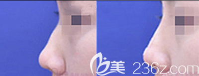 韓國(guó)奧來(lái)OLE整形外科醫(yī)院洪基錫駝峰鼻矯正案例