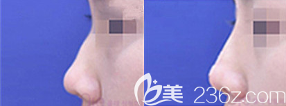 韓國奧來OLE整形外科醫(yī)院駝峰鼻矯正案例前后效果對比圖 韓國奧來OLE整形外科醫(yī)院駝峰鼻矯正案例前后效果對比圖