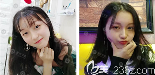 重慶華美雙眼皮