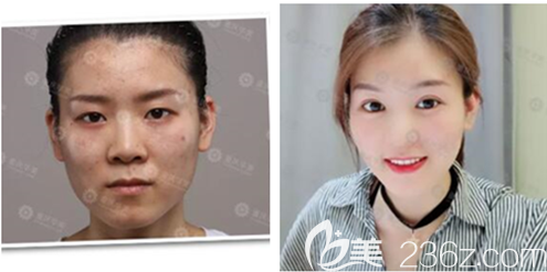 重慶華美上瞼下垂矯正