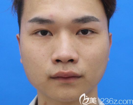 包頭華美整形醫(yī)院隆鼻前 包頭華美整形醫(yī)院隆鼻前