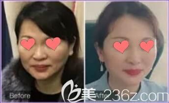 益陽德美DNA-童顏針真人案例對比圖