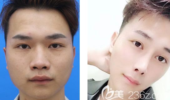 包頭華美白虎男士隆鼻前后對比照片 包頭華美白虎男士隆鼻前后對比照片