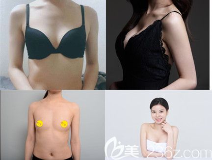 普羅菲耳隆胸案例 普羅菲耳隆胸案例