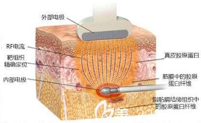 什么是黃金微雕？