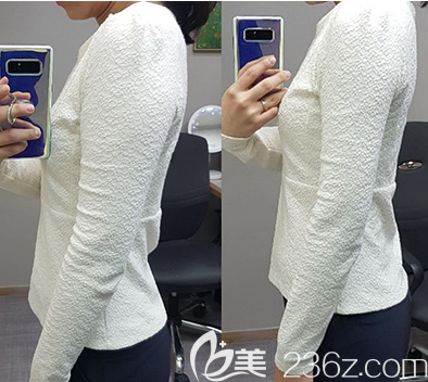 胳膊吸脂案例 胳膊吸脂案例