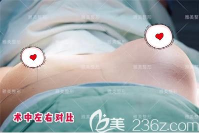 做完一側(cè)傲諾拉假體隆胸的效果對比 做完一側(cè)傲諾拉假體隆胸的效果對比